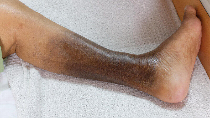 Peripheral Artery Disease
