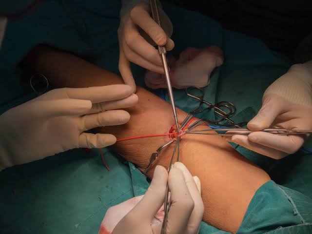 AV Fistula Surgery